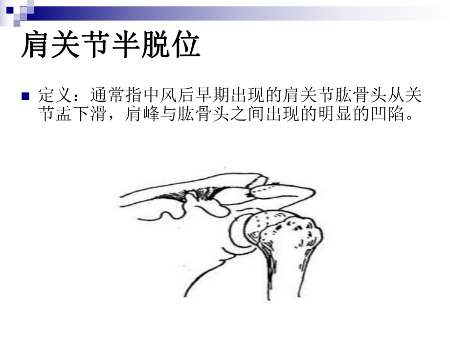 偏瘫患者肩关节常见问题课件.pptx_第2页