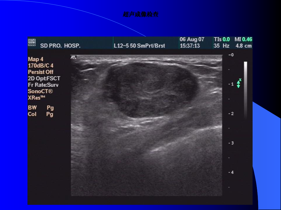 乳腺癌“毛刺征”病理基础与超声征象课件.ppt_第3页