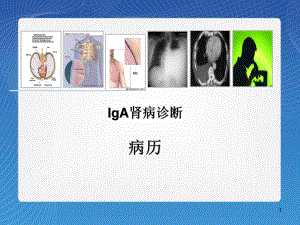 医学课件-IgA肾病诊断课件.ppt