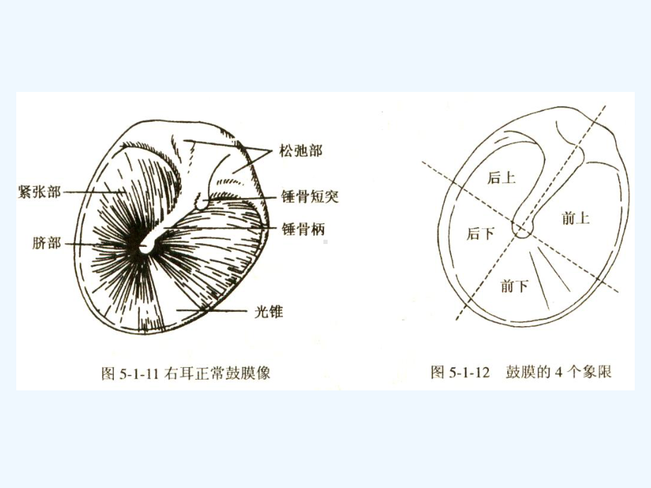 化脓性中耳炎及其并发症课件.ppt_第2页