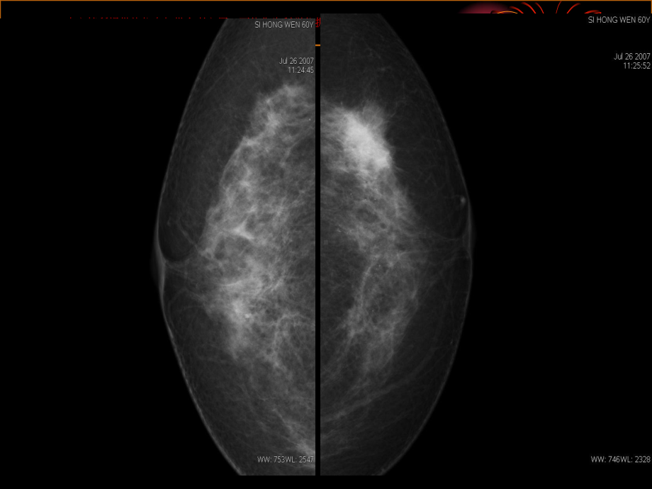乳腺钼靶精美培训课件.ppt_第2页