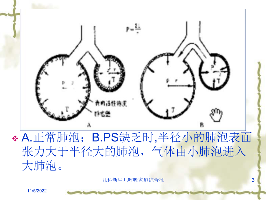 儿科新生儿呼吸窘迫综合征培训课件.ppt_第3页