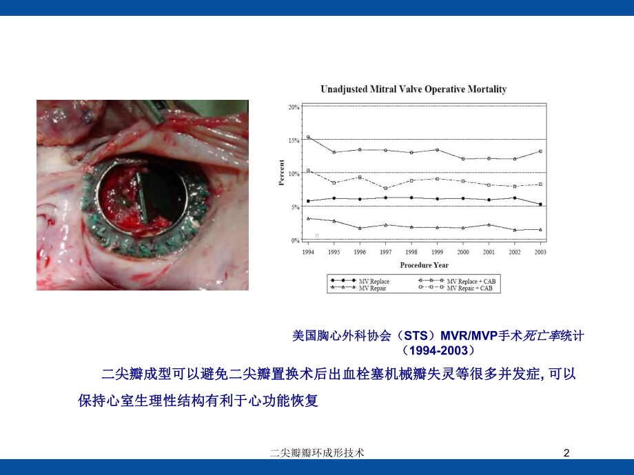 二尖瓣瓣环成形技术培训课件.ppt_第2页