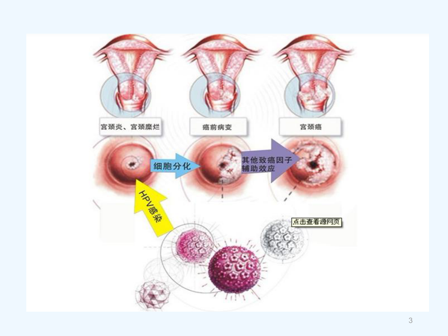 宫颈癌广泛性子宫切除盆腔淋巴结清扫手术配合课件.ppt_第3页