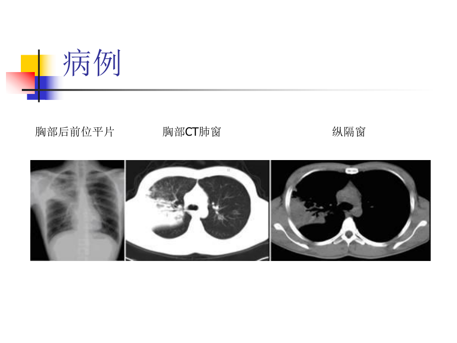 大叶性肺炎的影像诊断课件.ppt_第3页