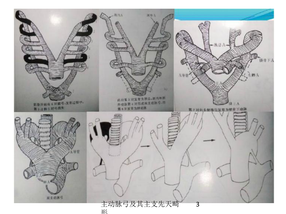 主动脉弓及其主支先天畸形培训课件.ppt_第3页