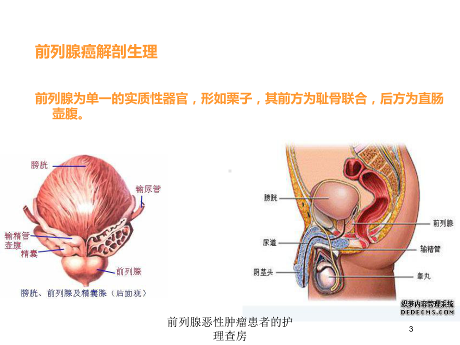 前列腺恶性肿瘤患者的护理查房培训课件.ppt_第3页