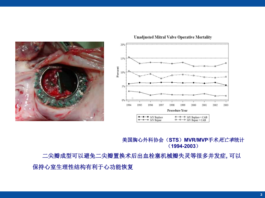 二尖瓣瓣环成形技术课件.ppt_第2页