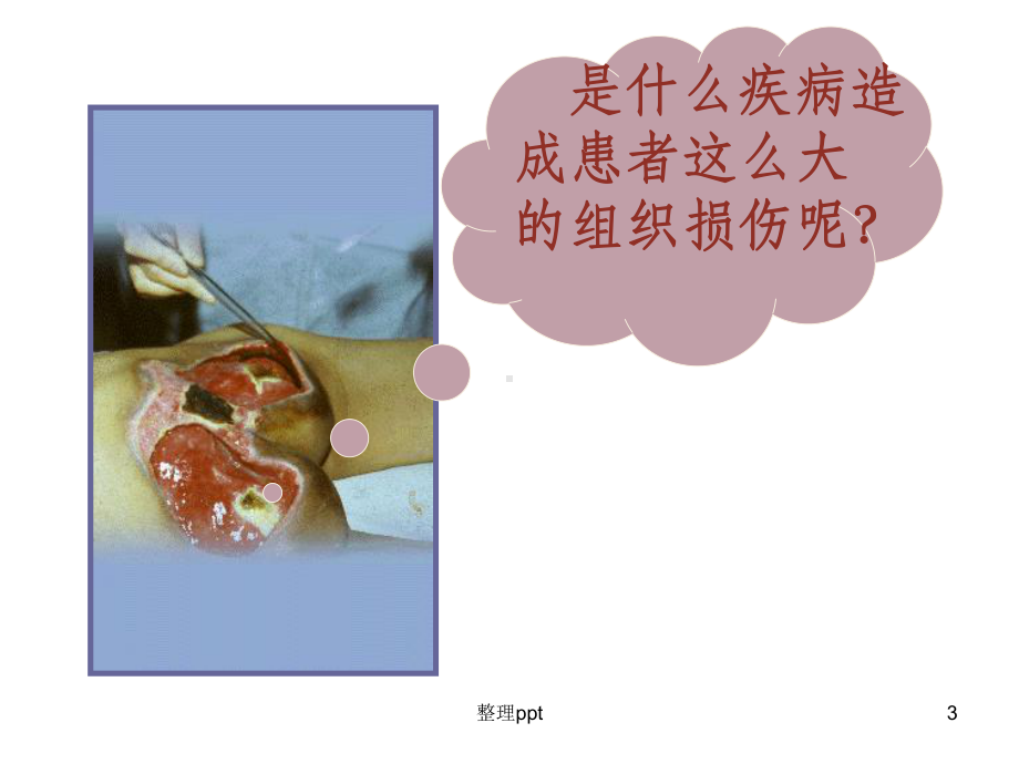 压疮预防和护理课件.ppt_第3页