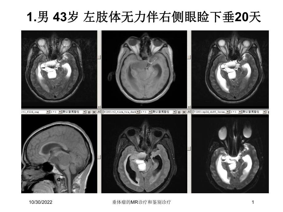 垂体瘤的MR诊疗和鉴别诊疗课件.ppt_第1页