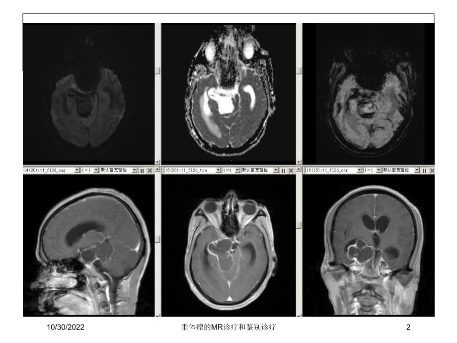 垂体瘤的MR诊疗和鉴别诊疗课件.ppt_第2页