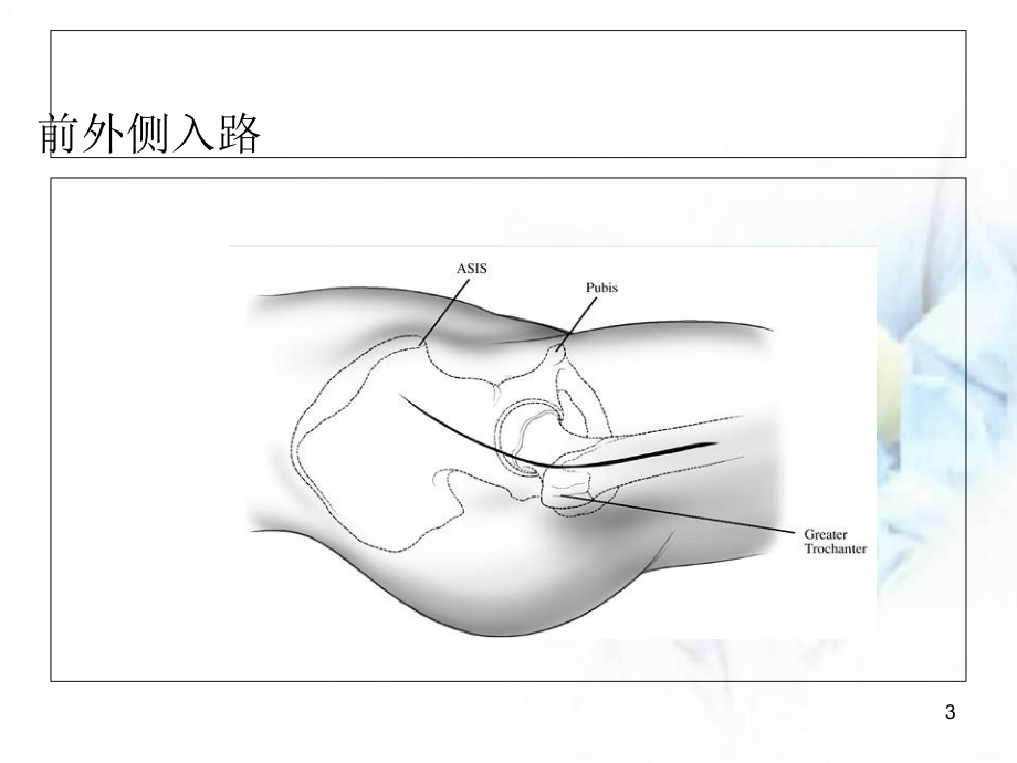 初次全髋关节置换手术技术要点教学课件.ppt_第3页