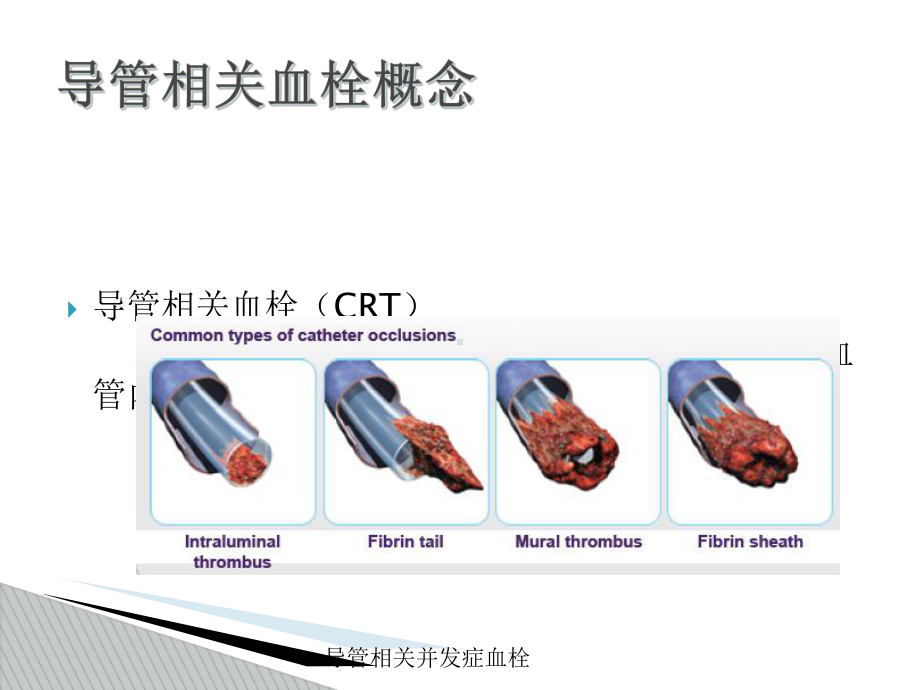 导管相关并发症血栓培训课件.ppt_第3页