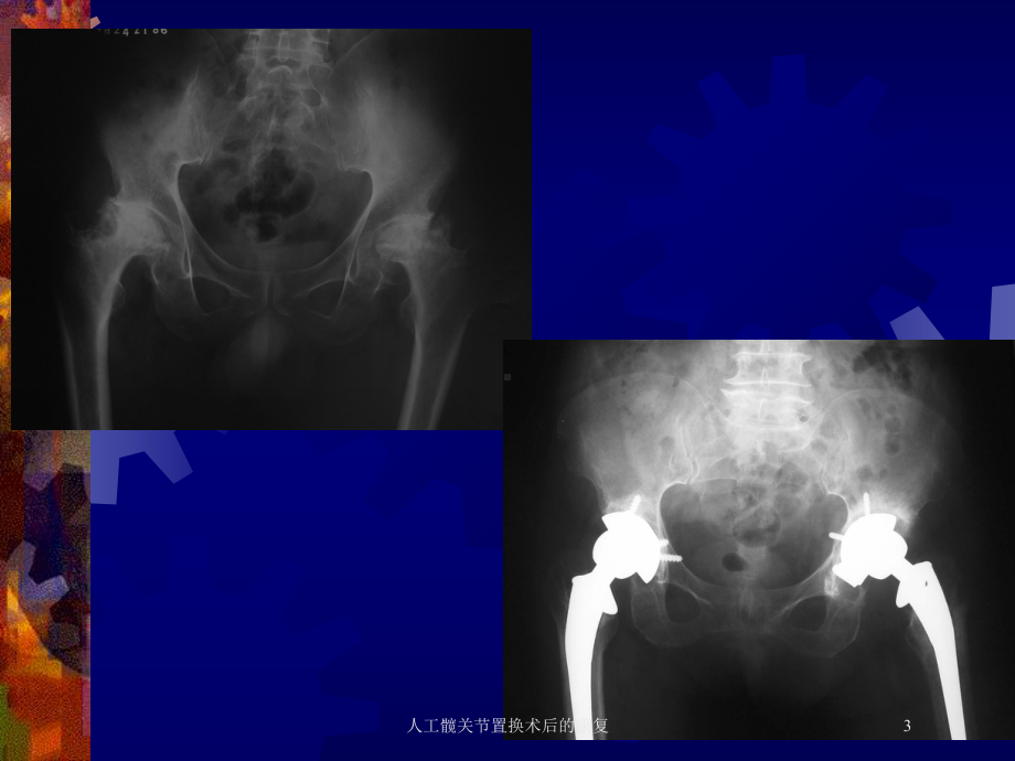 人工髋关节置换术后的康复培训课件.ppt_第3页