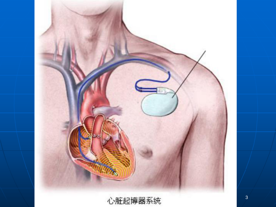 安装永久起搏器术后护理培训课件.ppt_第3页