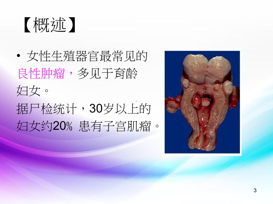 子宫肌瘤病人的术前术后护理课件.pptx_第3页