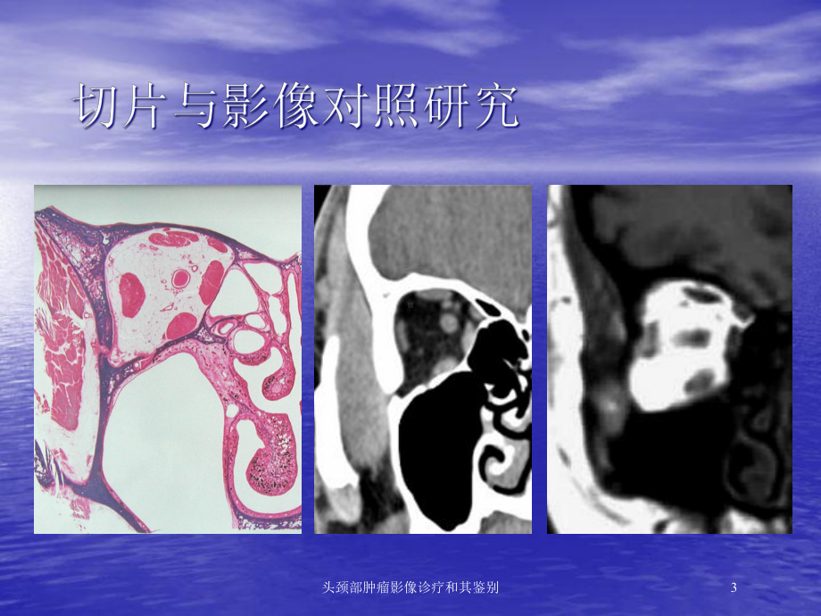 头颈部肿瘤影像诊疗和其鉴别培训课件.ppt_第3页