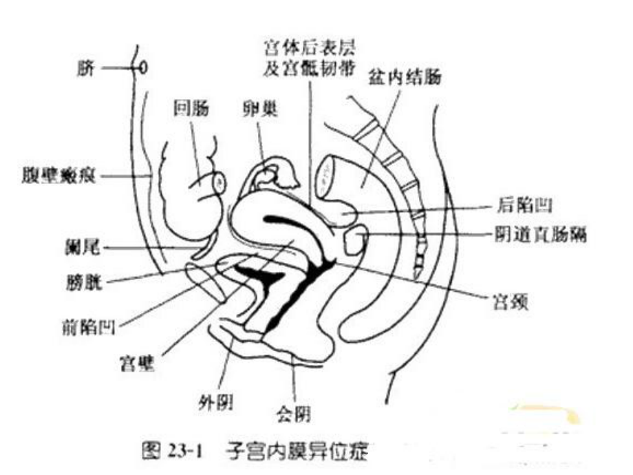 卵巢巧克力囊肿护理查房课件.ppt_第2页