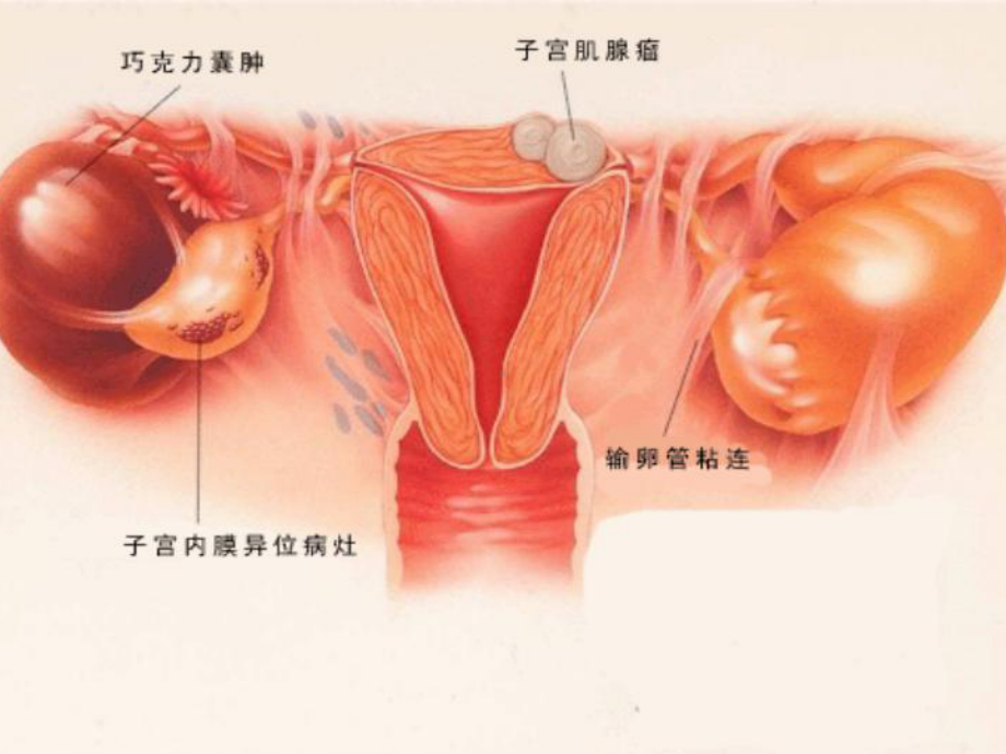 卵巢巧克力囊肿护理查房课件.ppt_第3页