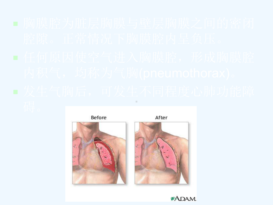 内科学-第十一章-自发性气胸课件.ppt_第2页