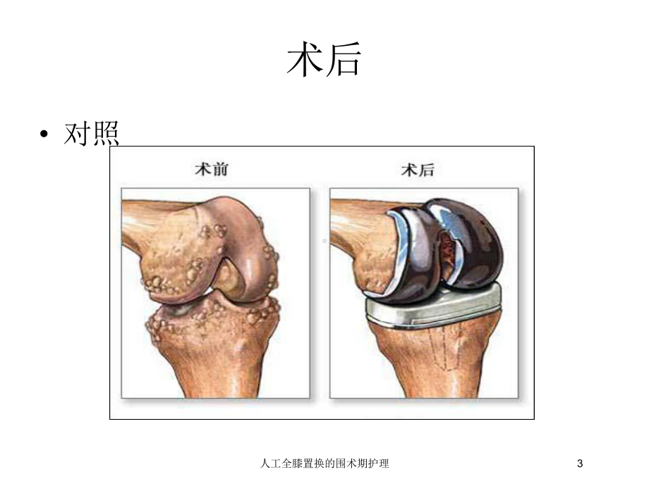 人工全膝置换的围术期护理培训课件.ppt_第3页