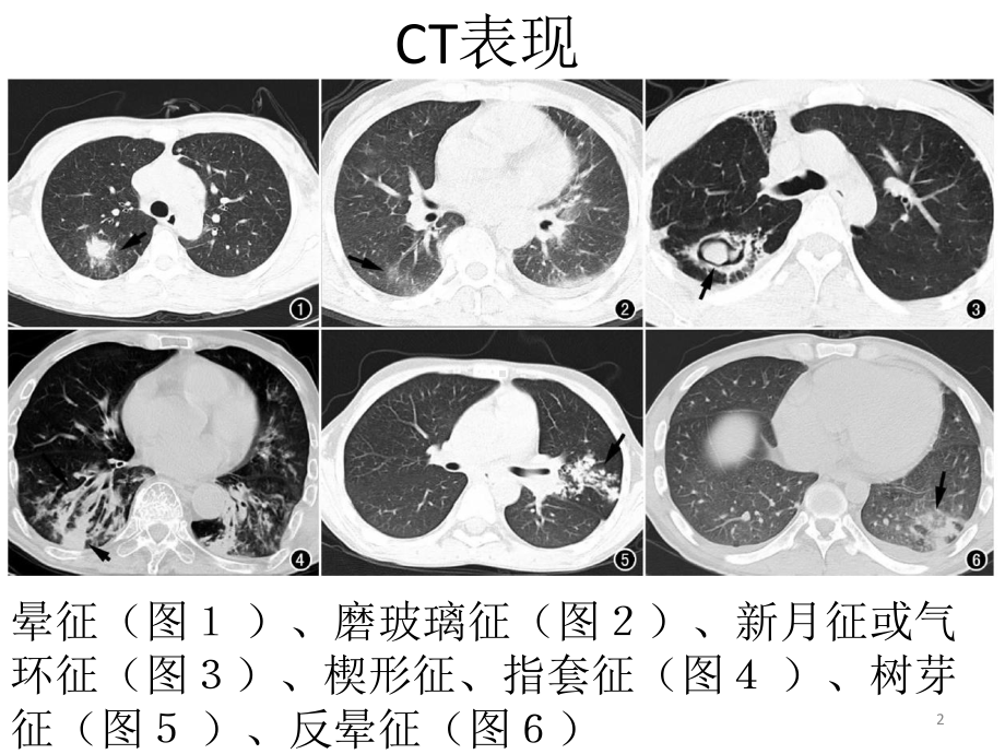 侵袭性肺真菌病课件.pptx_第2页