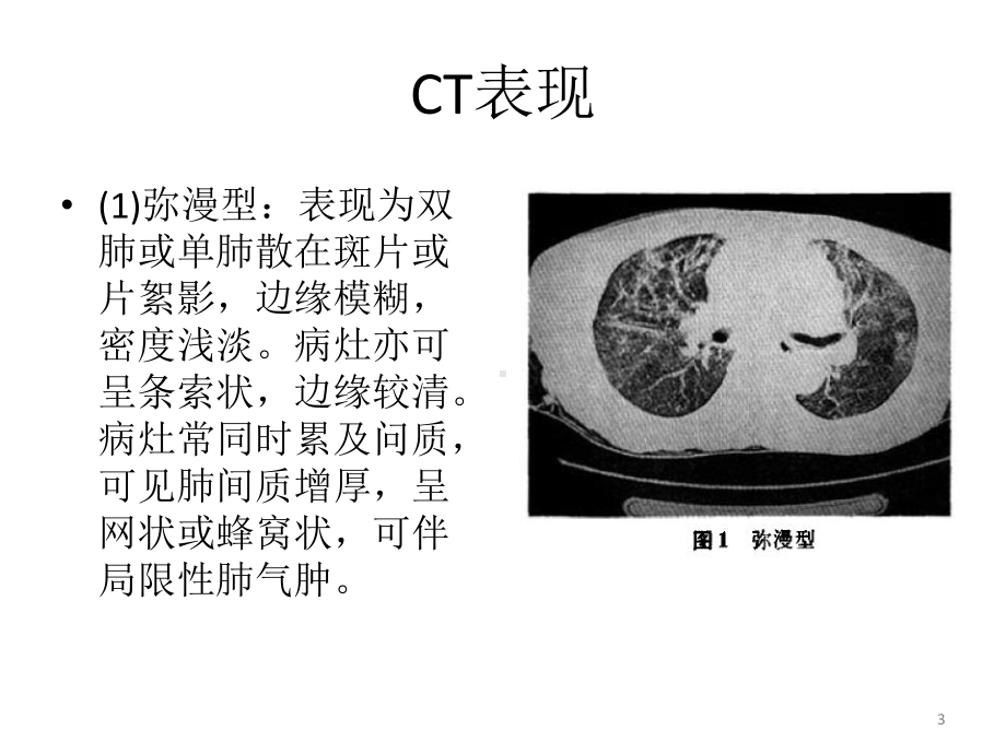 侵袭性肺真菌病课件.pptx_第3页