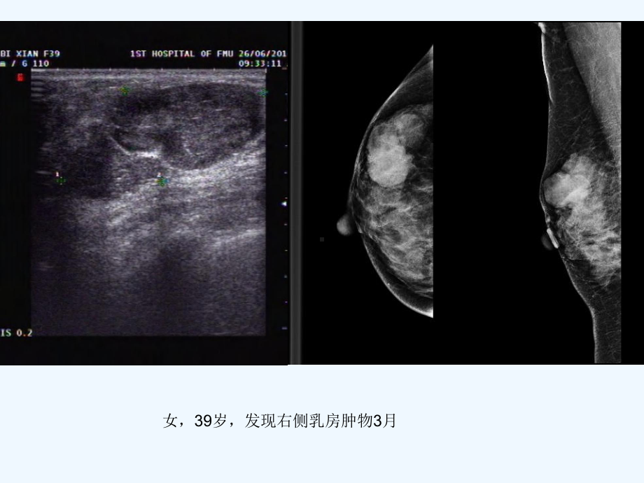 乳腺叶状肿瘤影像表现课件.ppt_第2页