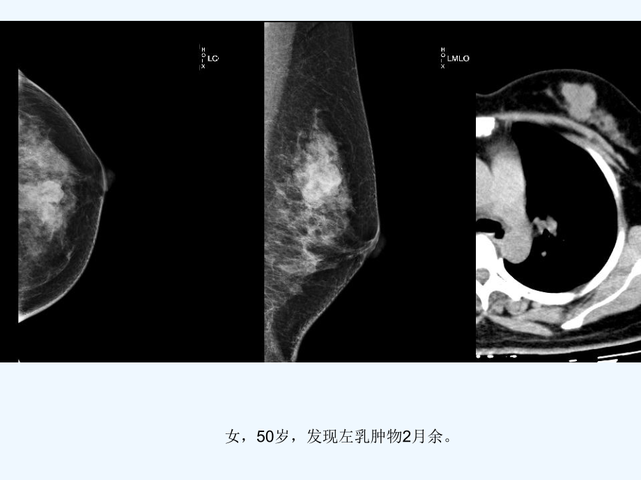 乳腺叶状肿瘤影像表现课件.ppt_第3页