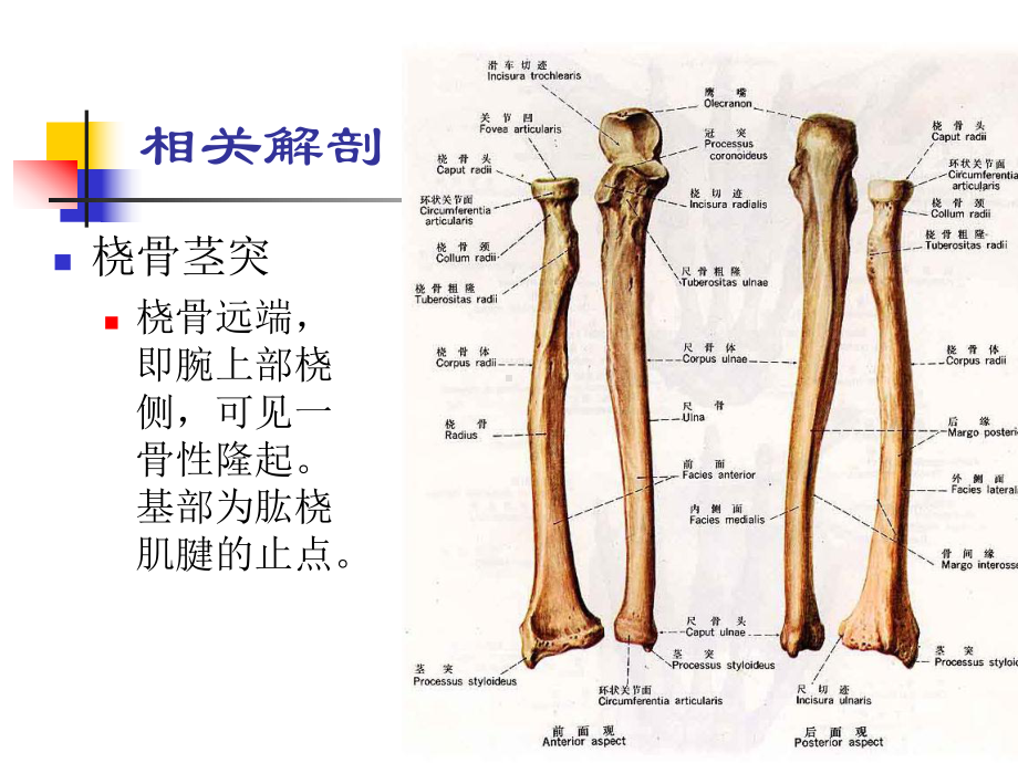 医学课件桡骨茎突部狭窄性腱鞘炎.ppt_第1页