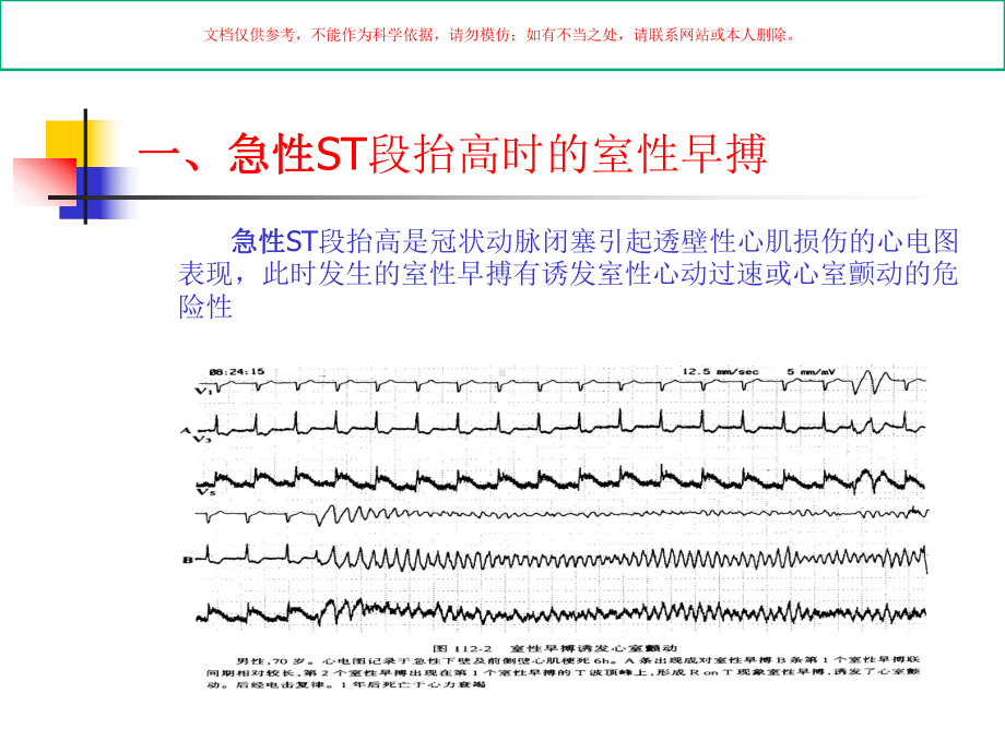 室性早搏医学知识专题讲座培训课件.ppt_第2页