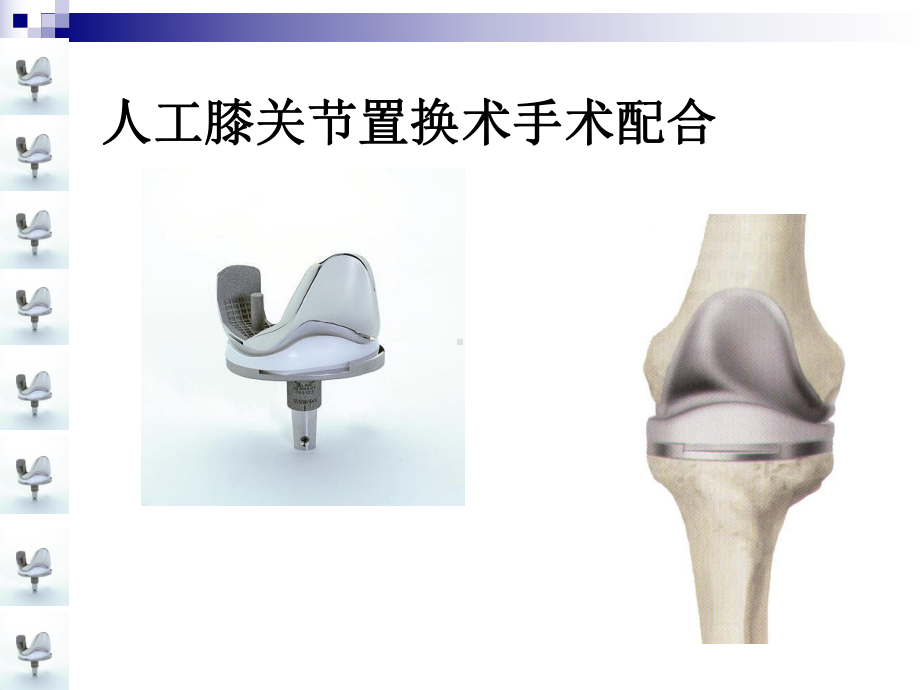 人工膝关节置换术手术配合课件-2.ppt_第1页