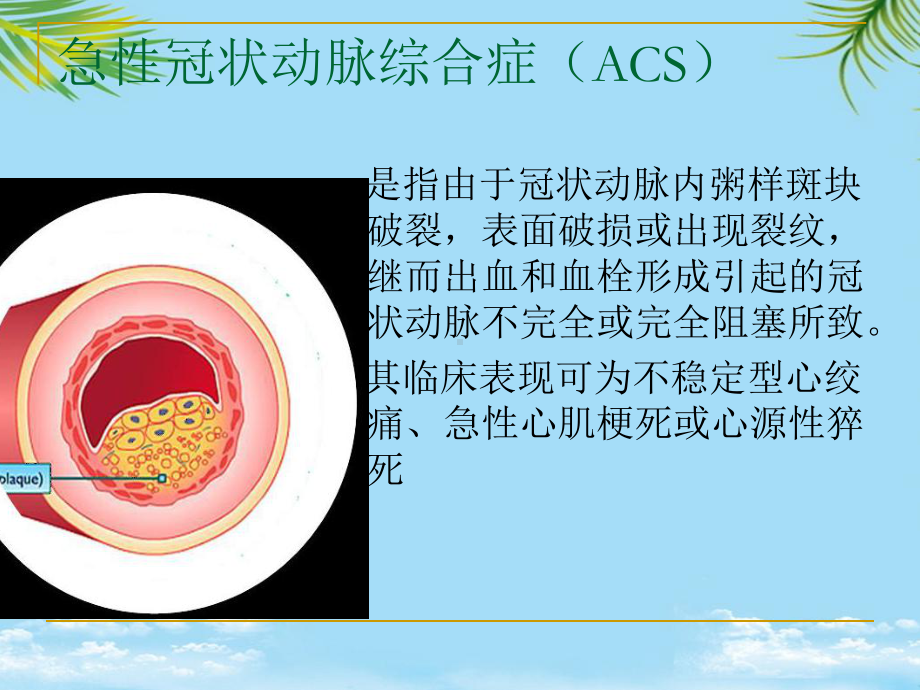 冠状动脉粥样硬化性心脏病急诊课件.ppt_第3页