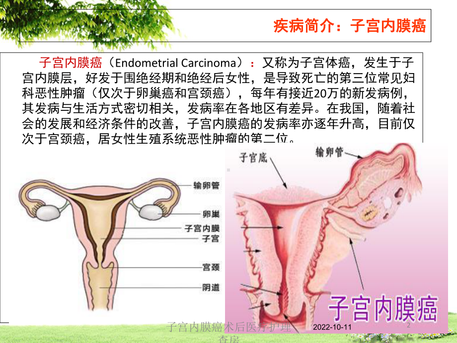 子宫内膜癌术后医疗护理查房课件.ppt_第2页