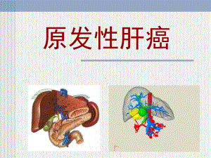 原发性肝癌-课件.ppt