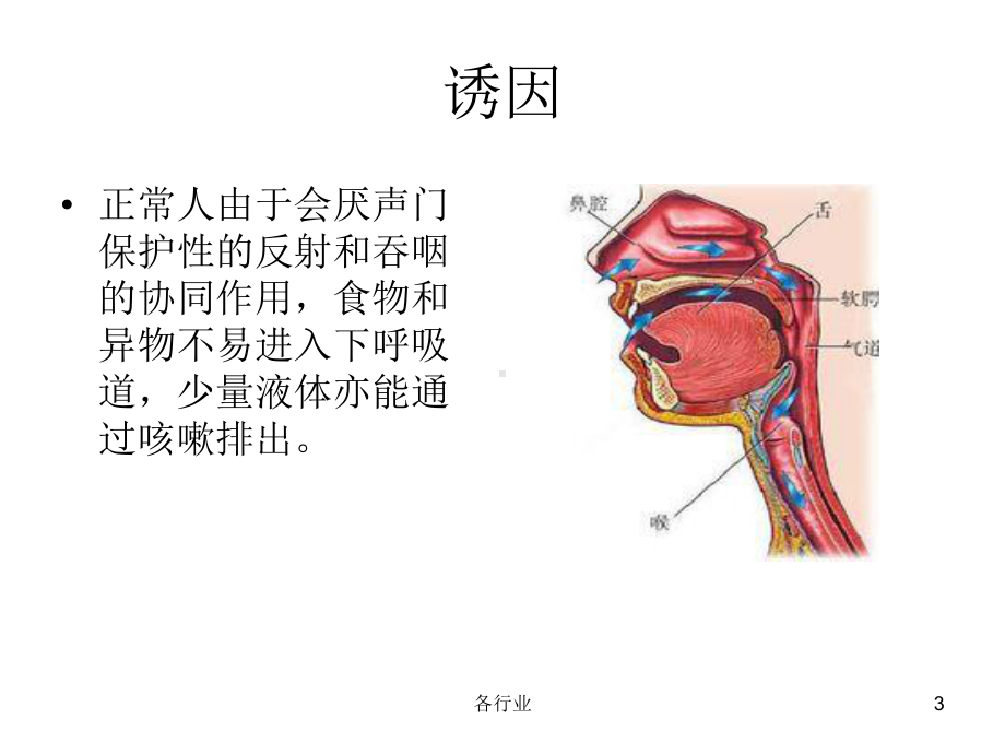 吸入性肺炎(特制医疗)课件.ppt_第3页