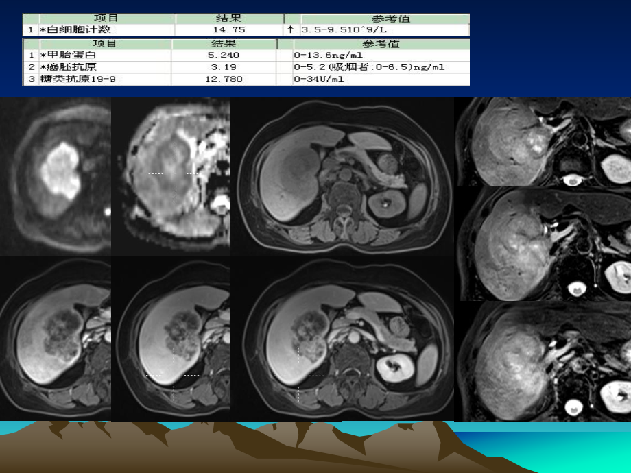医学肝脏常见占位性病变和其MR鉴别培训课件.ppt_第3页