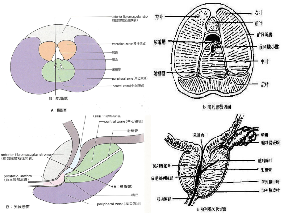 前列腺癌的穿刺活检培训课件.ppt_第2页