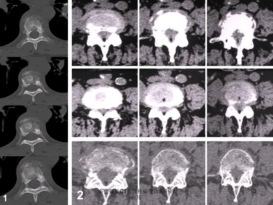 多层螺旋CT在脊柱病变诊断中的应用课件.ppt_第2页