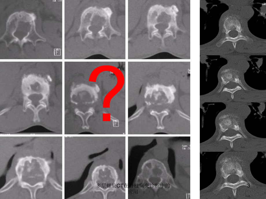 多层螺旋CT在脊柱病变诊断中的应用课件.ppt_第3页