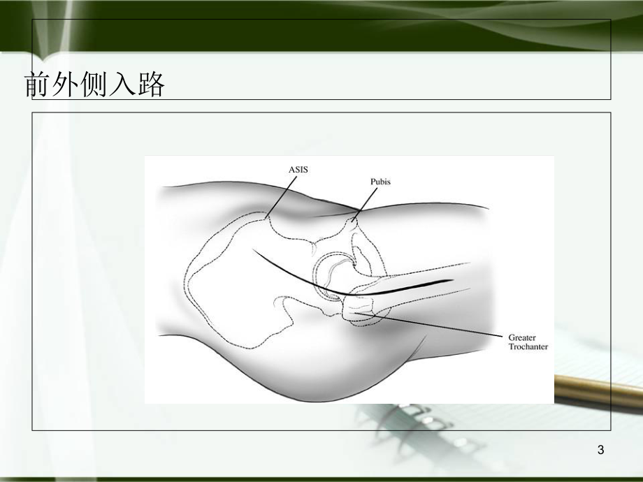 初次全髋关节置换手术技术要点学习课件.ppt_第3页