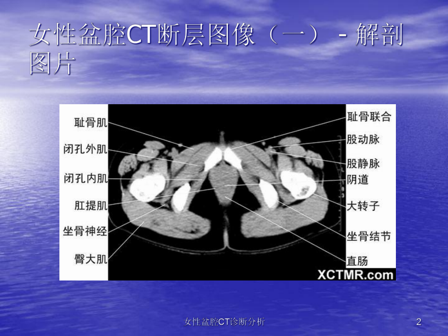 女性盆腔CT诊断分析培训课件.ppt_第2页