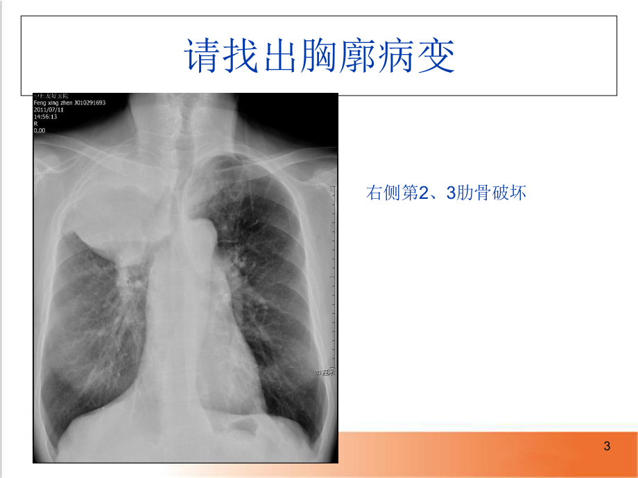 医学课件-胸片读片入门课件.ppt_第3页