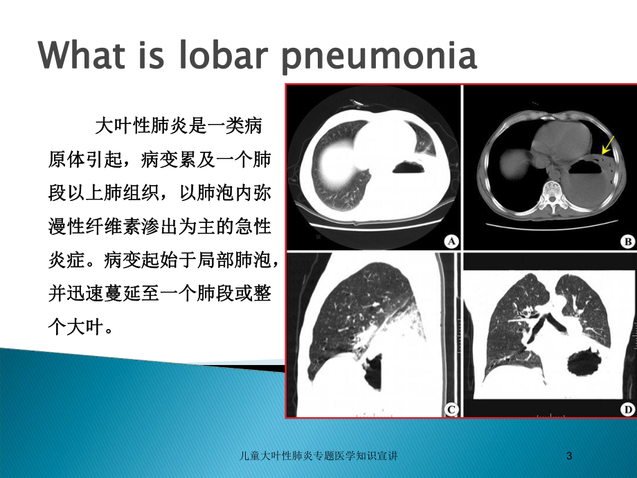 儿童大叶性肺炎专题医学知识宣讲培训课件.ppt_第3页