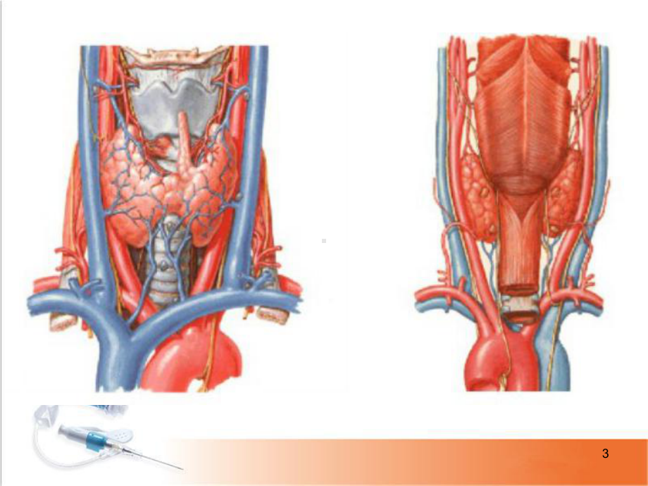 医学课件-常见甲状腺疾病的CT诊断课件.ppt_第3页