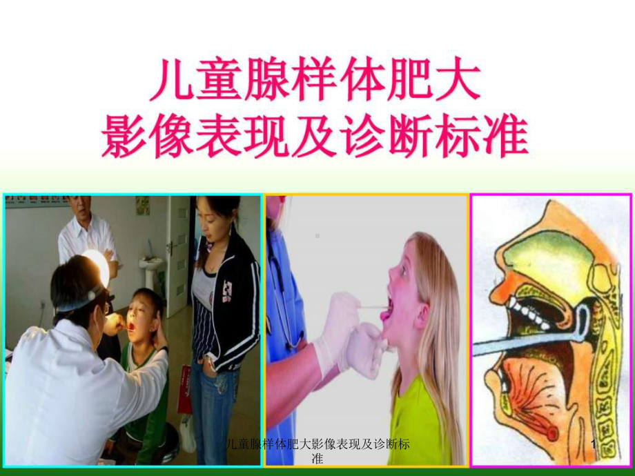 儿童腺样体肥大影像表现及诊断标准课件.ppt_第1页