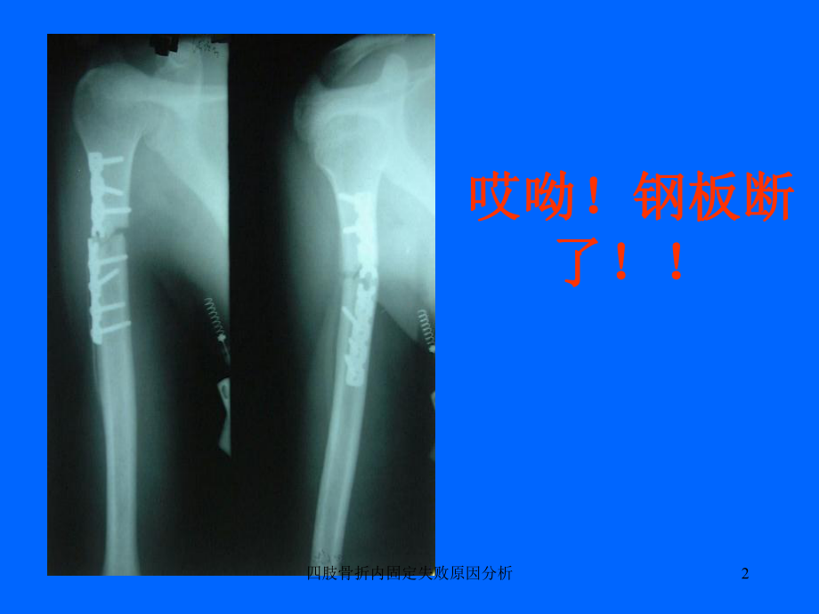 四肢骨折内固定失败原因分析课件.ppt_第2页