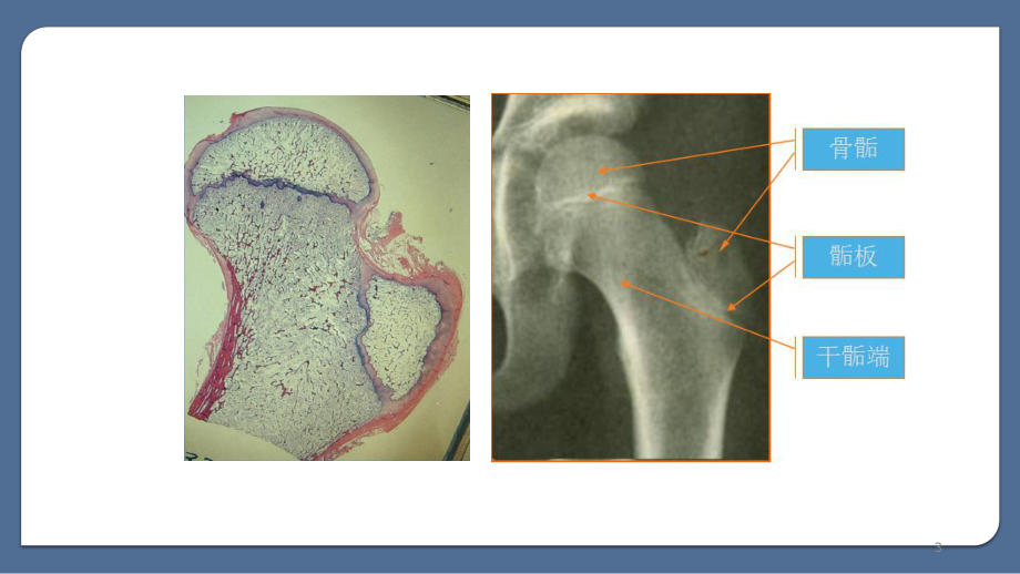 医学课件-骨骺损伤的影像学表现课件.pptx_第3页