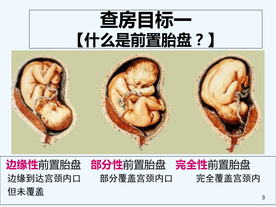 前置胎盘教学查房模板课件.ppt_第3页