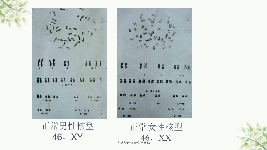 人类染色体畸变及疾病课件.ppt_第3页